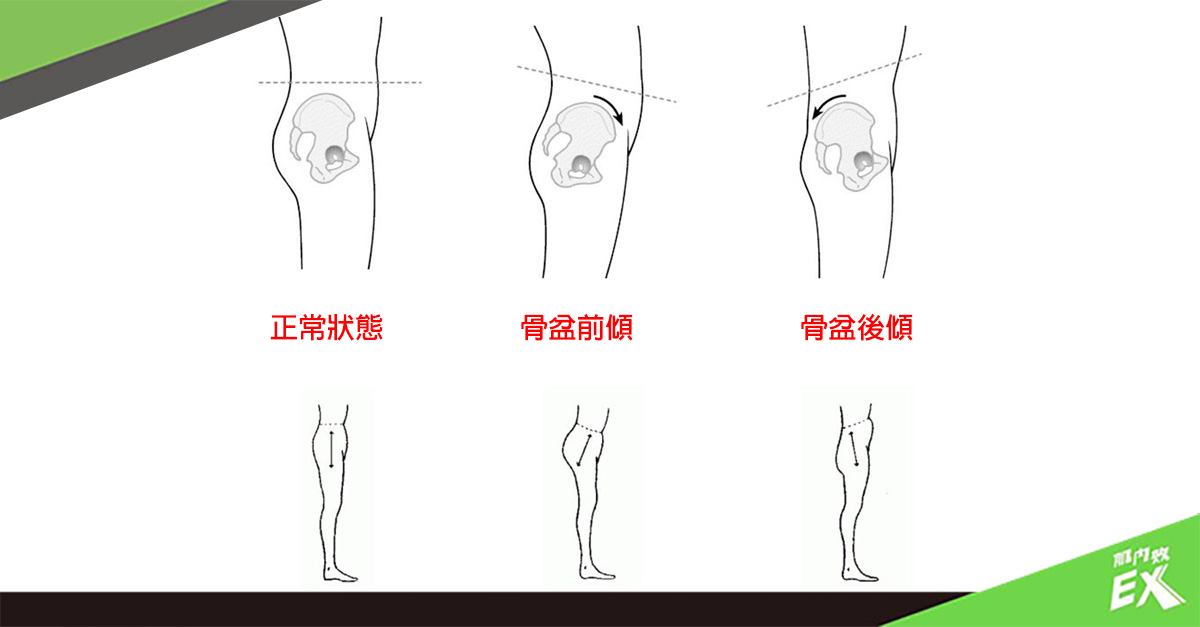 骨盆前傾不是女性專利！二招改善下交叉症候群