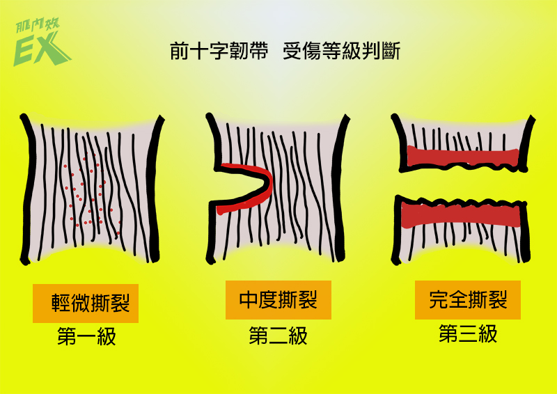 前十字韌帶評測