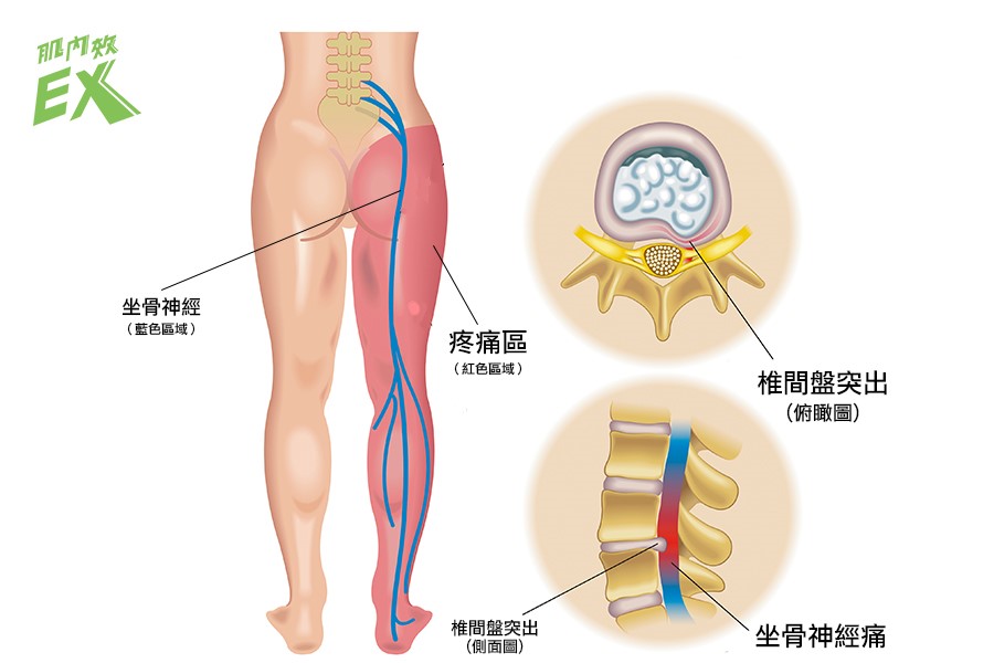 Greg坐骨神經痛1